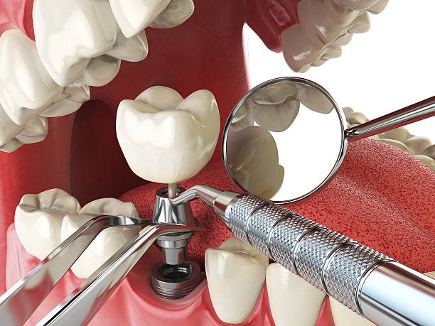 Best Broken or Cracked Tooth Emergency Dentist in Dane, WI
